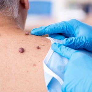 Mole and Cyst Removal | Catawba Valley Healthcare